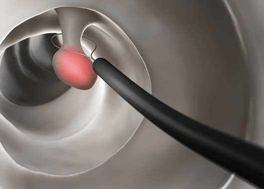 忙しい方でも安心。日帰りポリープ手術